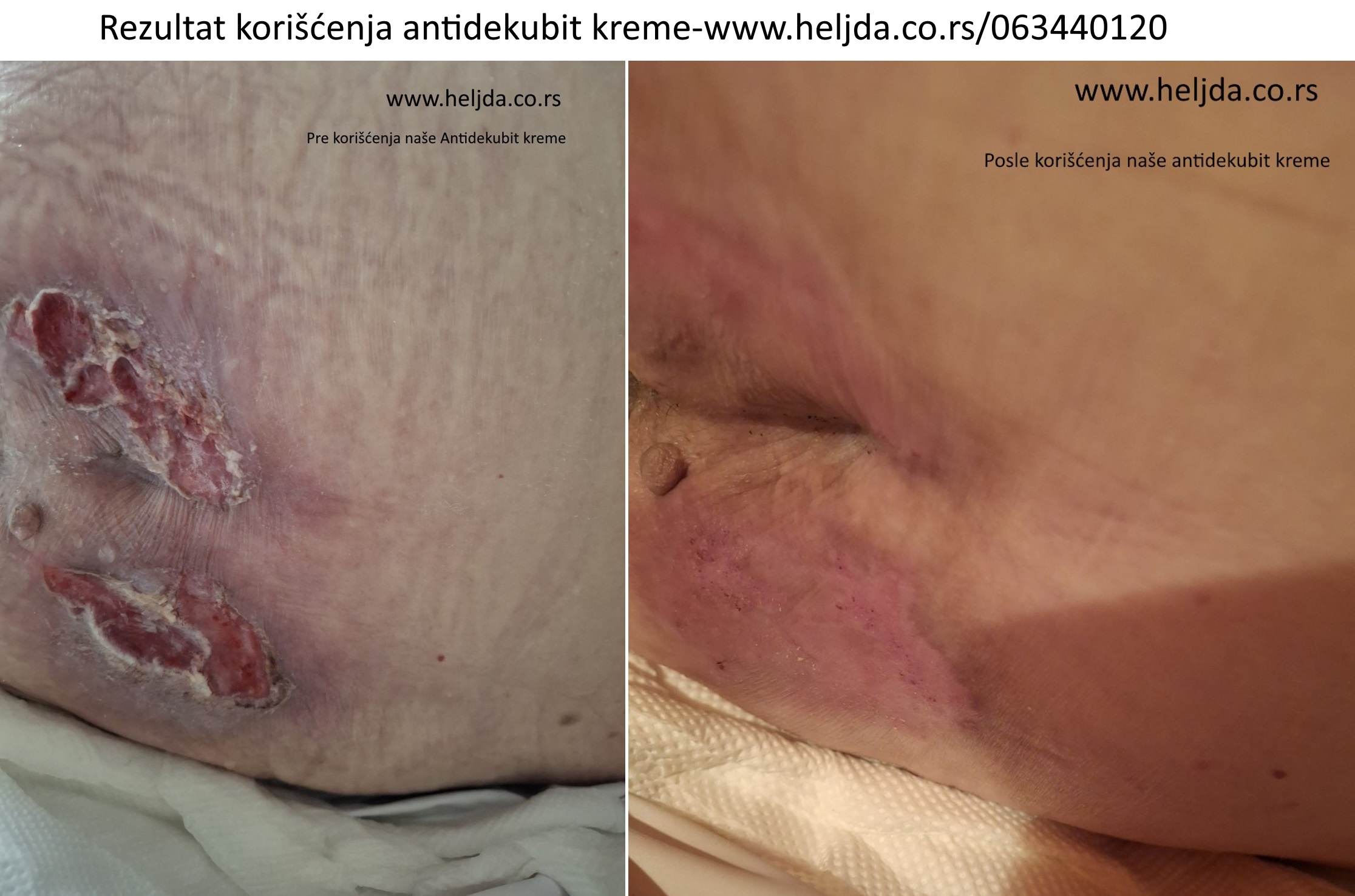 Lečenje dekubitalne rane