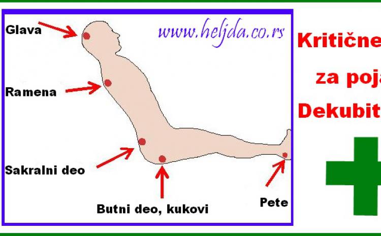 Kritične zone na telu za pojavu decubitusa