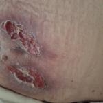 pre lečenja našom dekubit kremom