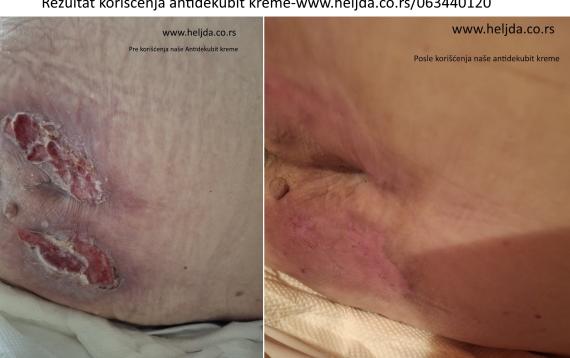 Lečenje dekubitalne rane